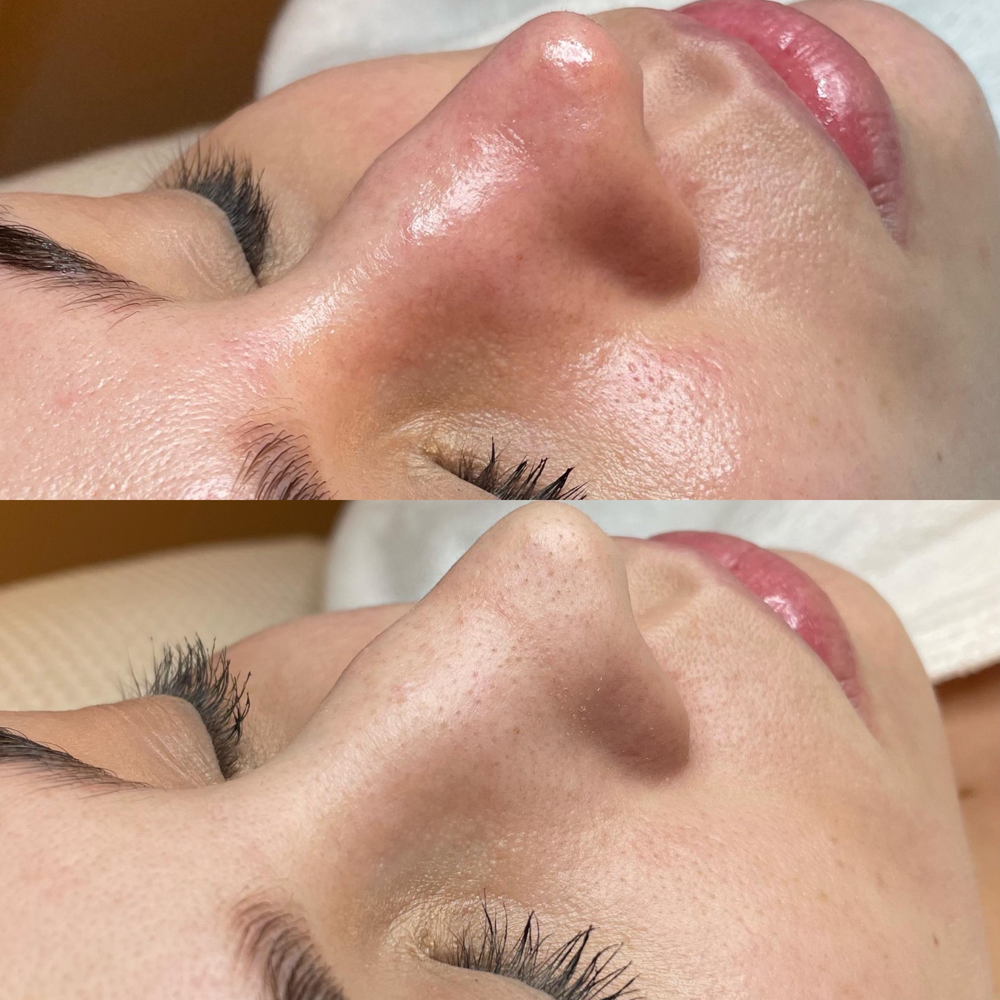 Antes e depois de protocolo facial
