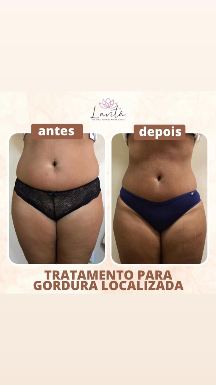 Registro de protocolo para gordura localizada