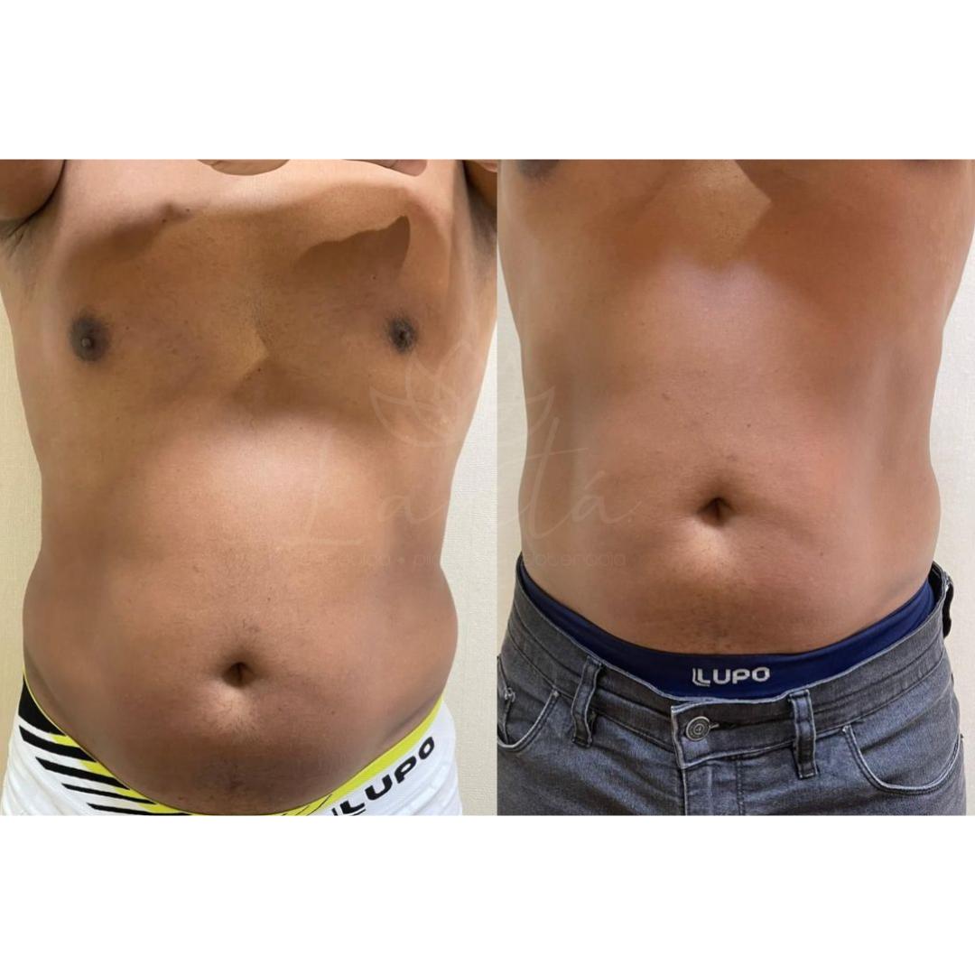 Antes e depois corporal