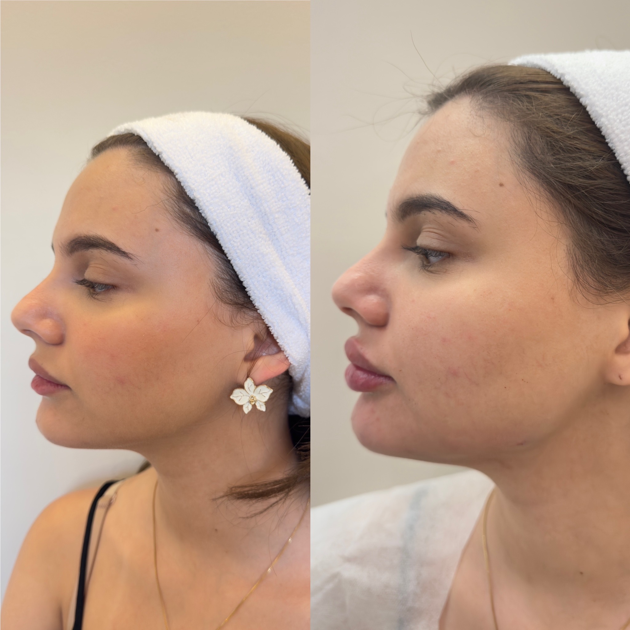 Antes e depois facial