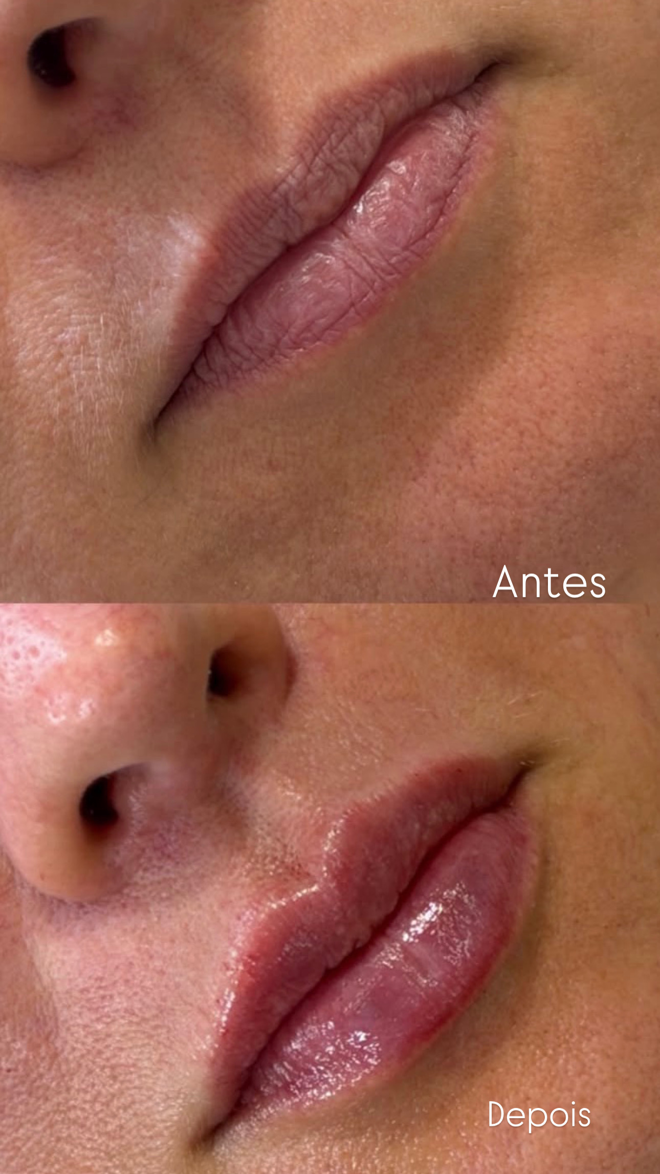 Antes e depois de protocolo estético
