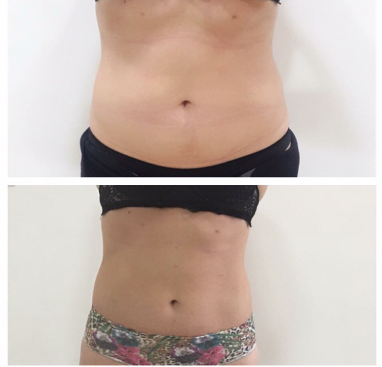 Antes e depois corporal
